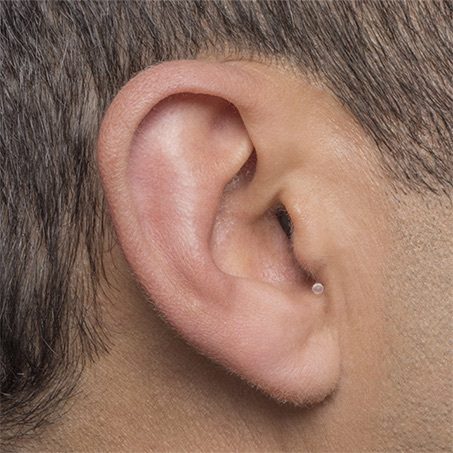 Invisible-In-Canal (IIC) hearing aid style